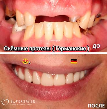 Стоматологи: Съёмные зубные протезы под ваши задачи - Вакуумные протезы: плотная — 4