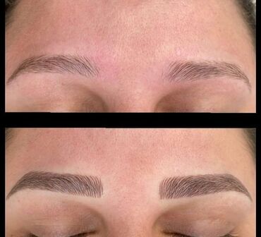 Kirpiklər, qaşlar: Seyrek formasiz qaslarin mikrobledinqle berpasi — 10