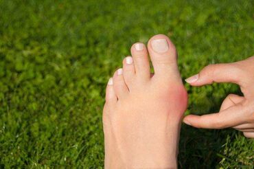 гвозди для ног: Корректоры для большого пальца ноги от вальгусной деформации(косточки