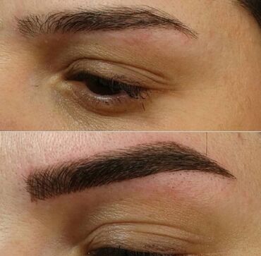Kirpiklər, qaşlar: Seyrek formasiz qaslarin mikrobledinqle berpasi — 3