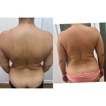 Hicama, zəli: Xidmət: Kupa terapiyası (quru və yaş/hicama), bel–boyun–çiyin masajı — 7