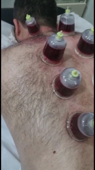 Hicama, zəli: Bəylər üçün = Hicama Və Zəli ✅Zəlinin Faydaları(Hirudoterapiya) — 15