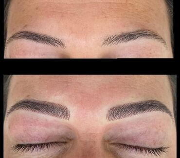 Kirpiklər, qaşlar: Seyrek formasiz qaslarin mikrobledinqle berpasi — 7