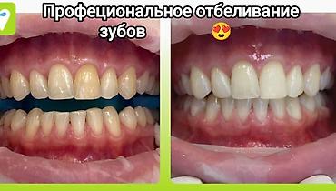 Стоматологи: Съёмные зубные протезы под ваши задачи - Вакуумные протезы: плотная — 10