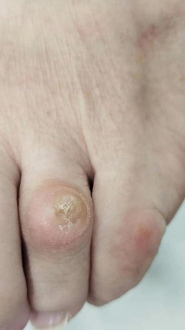 Маникюр: Коррекция вросших ногтей, Услуги подолога, Консультация — 6