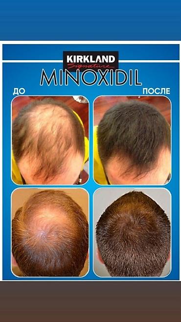 алопеция: Миноксидил Kirkland Signature — средство для стимуляции роста волос — 3