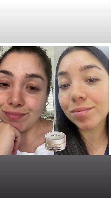 kosmetika qabı: Məhsul: Y-Peel Lightening Cream – ləkə qarşıtı və dəri tonu — 2