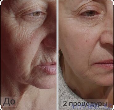 накладные брекеты для красоты: Косметология, Разглаживание и коррекция морщин, Консультация