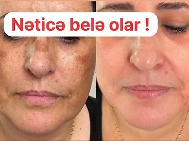 ☀️ GÜNƏŞ LƏKƏLƏRİ VƏ ÇİLLƏR SƏNİ NARAHAT EDİR? 🌸 Üzündəki ləkələrə