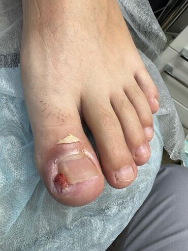 Маникюр, педикюр: Вросший ноготь. Коррекция вросшего сегмента путем удаления врастающих — 4