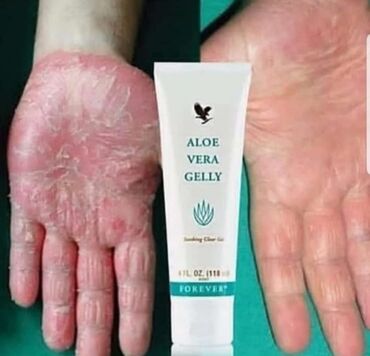 acnelyse krem qiyməti: Aloe kremi