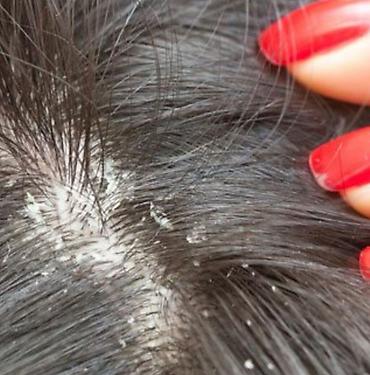 masaj yagi: Hello Hair Anti-Dandruff Shampoo – Golden Pearl • Məhsul növü: Kəpəyə — 2