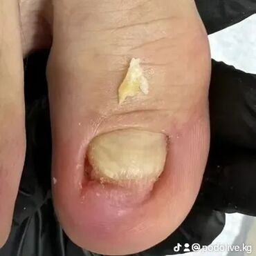 Маникюр, педикюр: Коррекция вросших ногтей, Выравнивание, Услуги подолога, Маникюр, Педикюр, С выездом на дом, Консультация, Одноразовые расходные материалы — 4