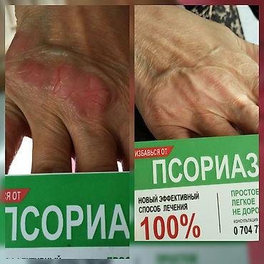Уход за телом: Здравствуйте! Найден эффективный способ от Псориаза. Я сам болею этой — 12