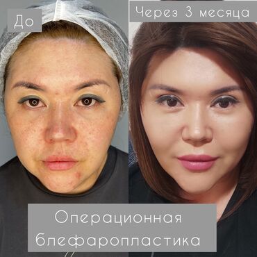 лазерная коррекция зрения: Операционная блефаропластика, запись и консультация по телефону