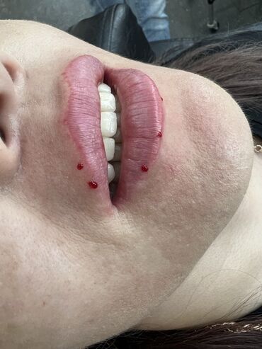 Косметология: Косметология, Маски, Мезотерапия, Удаление носогубных складок, Гипоаллергенные материалы, Консультация, Сертифицированный косметолог — 86