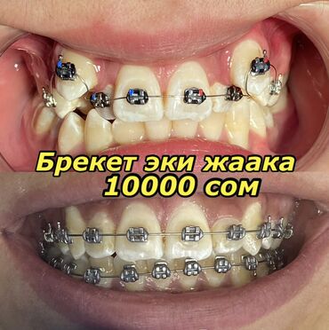 брекеты цена джалал абад: Стоматолог | Чистка зубов, Имплантация зубов, Фотопломбы | Консультация