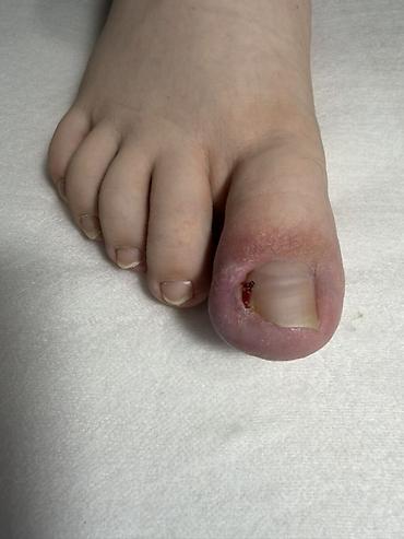 Маникюр: Коррекция вросших ногтей, Услуги подолога, Одноразовые расходные материалы — 1