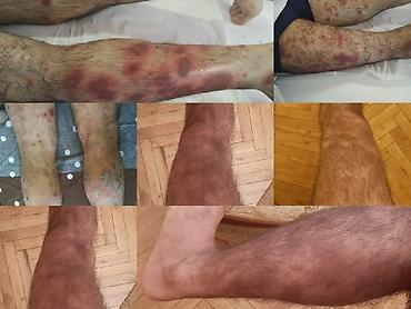 лечебный массаж: Острая боль в пояснице, ногах, грыжа. не поднимаются руки. Тогда — 2