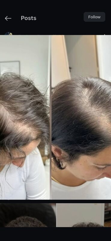 Saçlara qulluq: Saç üçün yağ, Saç tökülməsinə qarşı — 2