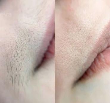 Эпиляция: Восковая депиляция для женщин и мужчин Подмышки - 500 сом — 9