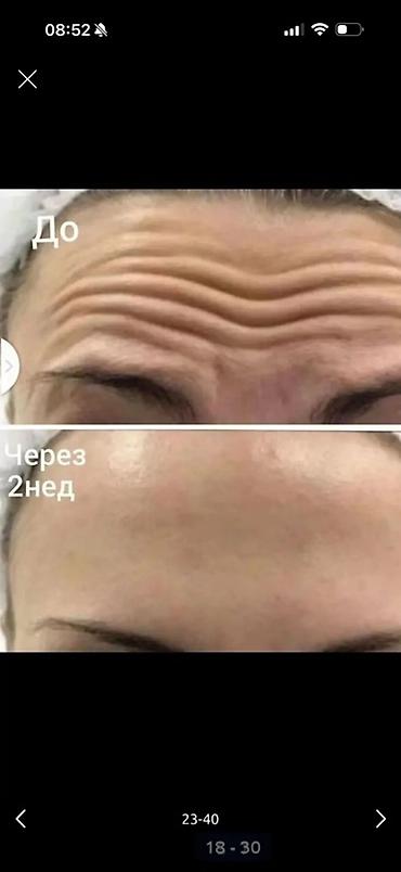 rf лифтинг: Косметология, Ботокс, Консультация, Гипоаллергенные материалы, Сертифицированный косметолог — 2