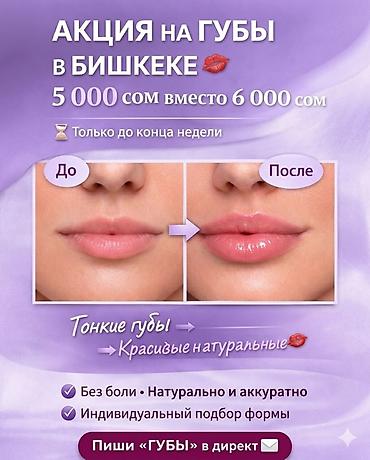смас лифтинг: Увеличение и коррекция губ в Бишкеке - Акция: 5 000 сом вместо 6 000 — 3