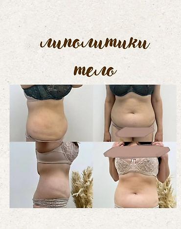 Красота и здоровье: Lipo Lab V-Line Solution — инъекционный липолитик для коррекции — 2