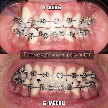 Ортодонтическое лечение на металлических брекет‑системах. -