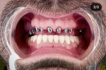 Stomatologiya: 💫Ramazan ayı ilə əlaqədar Kampaniya✨🌟⭐💫 🌊🔥Diş Həkimi 🔥🌊 Qiymətləri — 13