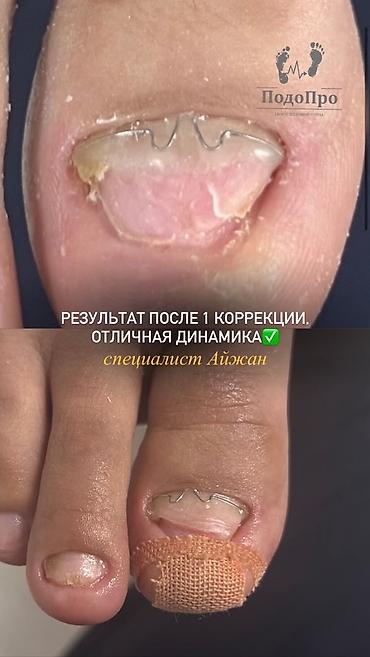 Коррекция вросших ногтей, Услуги подолога, Одноразовые расходные материалы