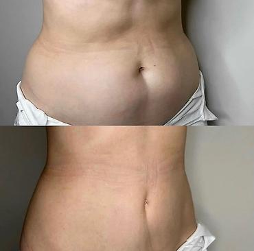 Красота и здоровье: Lipo Lab V-Line Solution — инъекционный липолитик для коррекции — 6