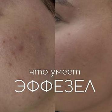 Эффезел — гель для ухода за кожей, склонной к акне. Комбинированная