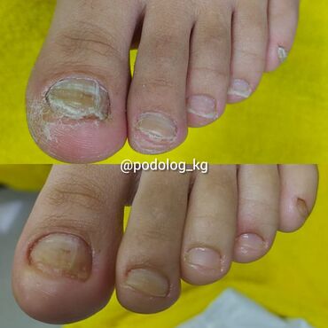 Маникюр, педикюр: Коррекция вросших ногтей, Маникюр, Педикюр, Услуги подолога, Консультация — 10