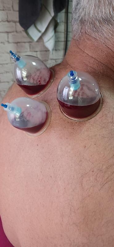 Hicama, zəli: HİCAMA EDİRƏM 30 AZN bankalar 1 dəfəlikdir sonra atilir 1 seansa 7 — 2