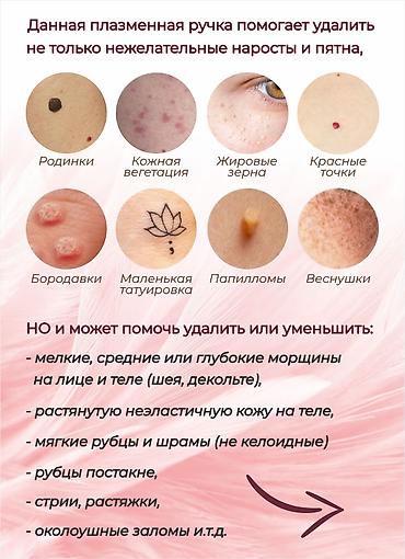 co2 лазер: Плазма-пен — аппарат для косметологических процедур Компактный — 3