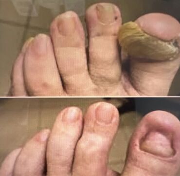 Маникюр, педикюр: Вросший ноготь. Коррекция вросшего сегмента путем удаления врастающих — 11