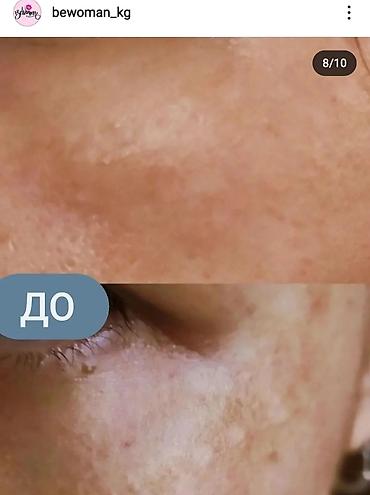 expigment реальные отзывы: Экспигмент Expigment от ПИГМЕНТАЦИИ,для лечения пигментных пятен Не — 4