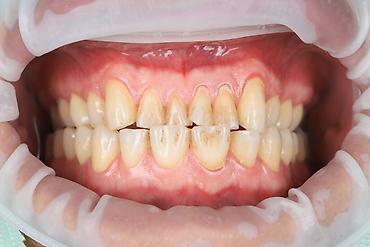 mix pro: Стоматология Canon 6D MARK 2 CANON MACRO 100mm GODOX MF12 вспышки — 10