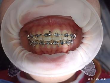 Ортезы: Ортодонтическое лечение: установка брекет‑системы на нижнюю челюсть - — 10