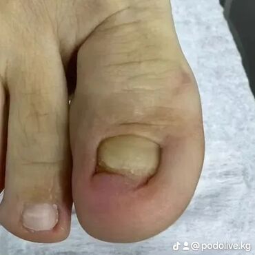 Маникюр, педикюр: Коррекция вросших ногтей, Выравнивание, Услуги подолога, Маникюр, Педикюр, С выездом на дом, Консультация, Одноразовые расходные материалы — 3