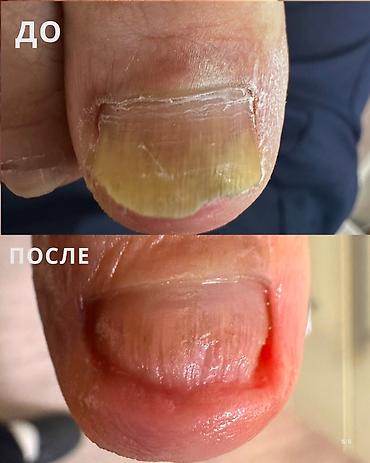 ногтей: Укрепление ногтей, Услуги подолога, Консультация — 1