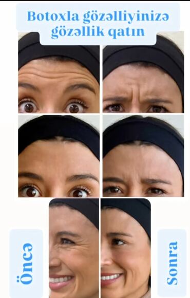 Kosmetologiya: Botox 70azn Qirislara vaxtinda mudaxile edin.Botoxla zamanı dayandirin