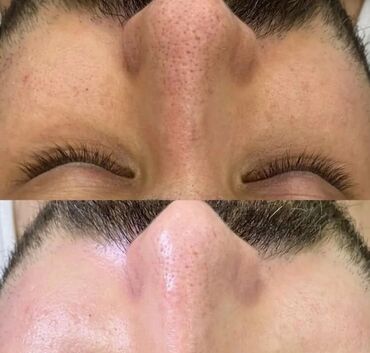 Kosmetologiya: Bəylər üçün = Lazer Epilasiyasi✅Hicama və — 8