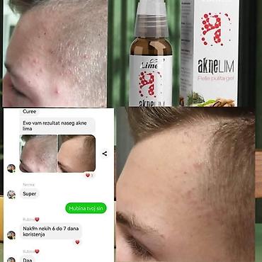 Nega kože: Aknelim gel 30ml – 100% delotvoran saveznik protiv akni Iskoristite — 3