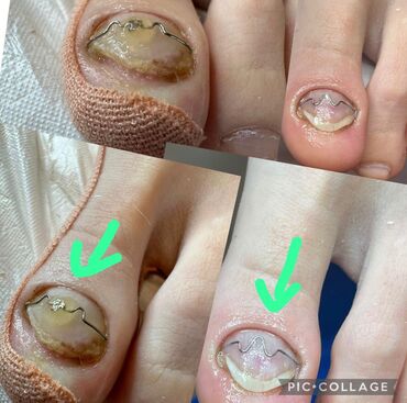 Маникюр, педикюр: Ремонт сломаных ногтей, Снятие, Укрепление ногтей, Услуги подолога, Одноразовые расходные материалы, Консультация, С выездом на дом — 12