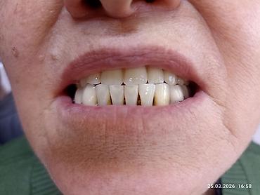 Ортезы: Съемные частичные зубные протезы - Тип: частичные протезы для верхней — 17