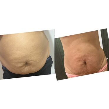 Hicama, zəli: Xidmət: Kupa terapiyası (quru və yaş/hicama), bel–boyun–çiyin masajı — 4