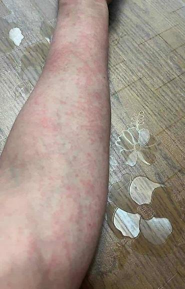 Nega kože: Ide leto,deca su u majicama i sorcicima. Padovi sa — 6
