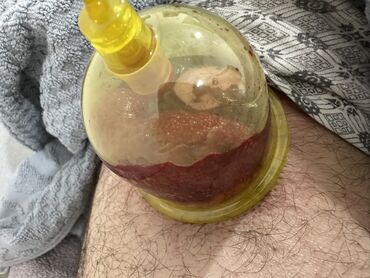 Hicama, zəli: Xidmət: Kupa terapiyası (quru və yaş/hicama), bel–boyun–çiyin masajı — 13